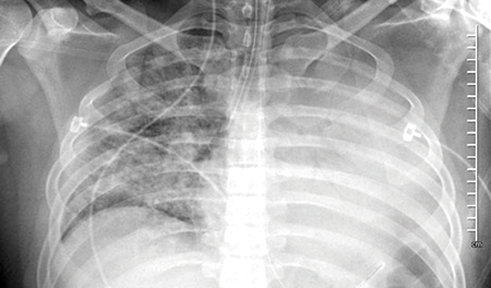 Chest X-ray of a patient with vaping-associated lung injury (EVALI) showing bilateral infiltrates upon ICU admission.